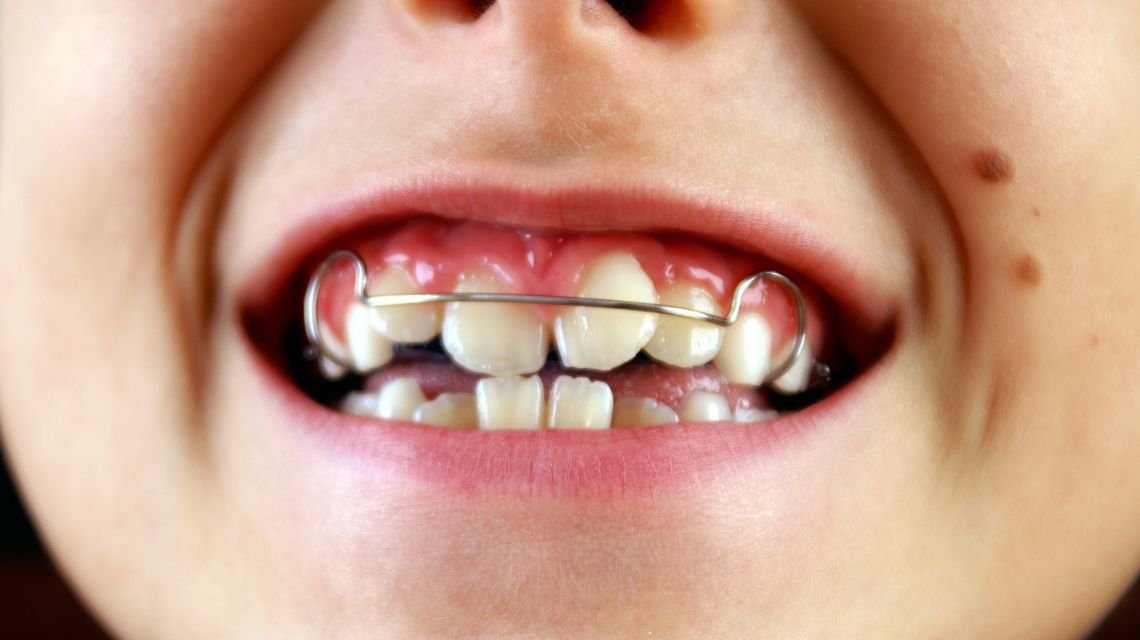 Habit Breaking Appliances