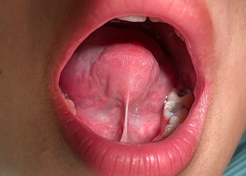 Tongue Tie / Lip Tie Centre